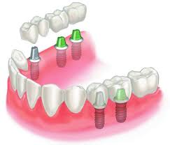 Cấy ghép implant cho răng hàm như thế nào? 