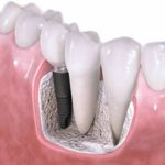 Cấy ghép implant cho răng hàm như thế nào?