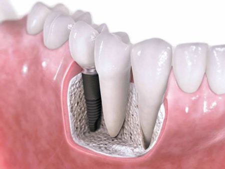 Cấy ghép implant cho răng hàm như thế nào? 
