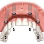 Cấy ghép trụ implant có ảnh hưởng sức khỏe không