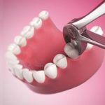 Nhổ răng hàm không đau tại nha khoa Đăng Lưu