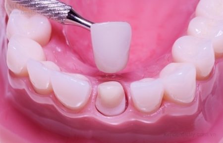 Răng đã lấy tủy có nên bọc răng sứ thẩm mỹ không?