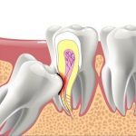 Răng khôn là gì? Khi nào thì nên nhổ bỏ răng khôn?