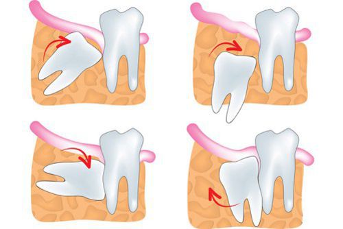 Răng khôn là gì? Khi nào nên nhổ bỏ răng khôn? 2