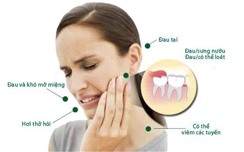 Răng khôn là gì? Khi nào nên nhổ bỏ răng khôn? 3