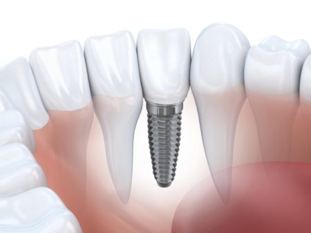 Trồng răng Implant
