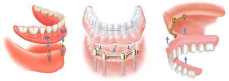 Implant có thể giúp phục hình cả hàm răng