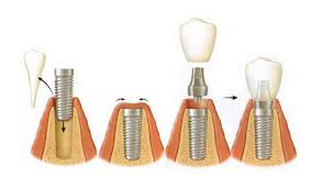 Cấy ghép răng implant như ý