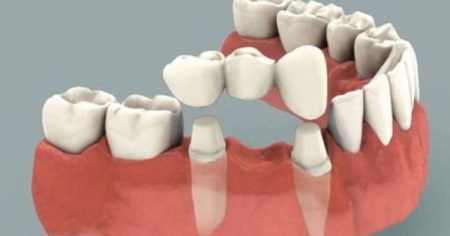 Phương pháp trồng răng hiệu quả