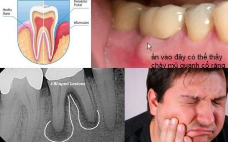 Viêm chân răng số 8 nguyên nhân và cách điều trị