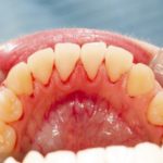 Viêm chân răng số 8 - Niềng răng thẩm mỹ uy tín