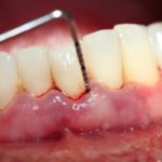 Viêm lợi chảy máu chân răng – Những điều cần lưu ý