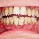 Lấy cao răng có ảnh hưởng không? Nha khoa tư vấn