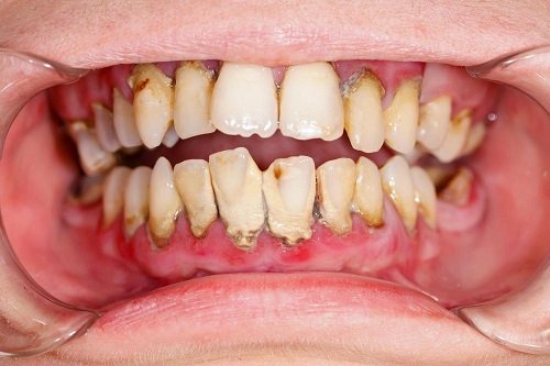 Lấy cao răng có ảnh hưởng không? Nha khoa tư vấn 1