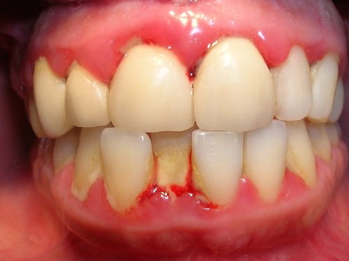 Lấy cao răng có ảnh hưởng không? Nha khoa tư vấn 2