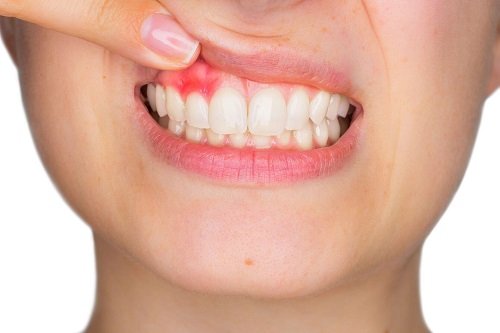 Răng sứ bị cộm gây ra nhiều bệnh lý nguy hiểm