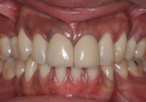 Nguyên nhân khiến bọc răng sứ bị thâm lợi