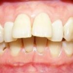 Bọc răng sứ chỉnh hô hiệu quả ra sao sau khi thực hiện?
