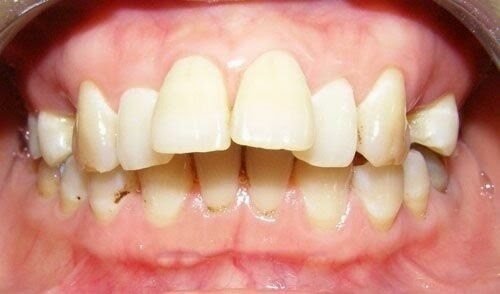 Bọc răng sứ chỉnh hô hiệu quả ra sao sau khi thực hiện?-1