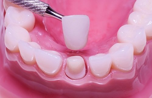 Bọc răng sứ có ảnh hưởng gì không? Nha khoa tư vấn-2