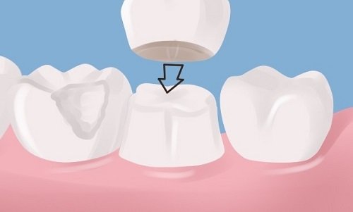 Bọc răng sứ không cần mài răng áp dụng cho trường hợp nào?-3