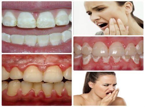 Những tác hại của việc tẩy trắng răng thiếu kiến thức nha khoa 3
