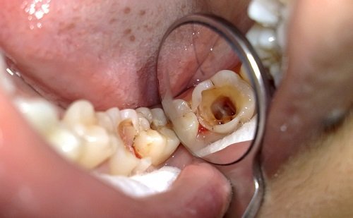 Bọc răng hàm bị sâu có đau không? Tìm hiểu cách xử lý răng sâu-2