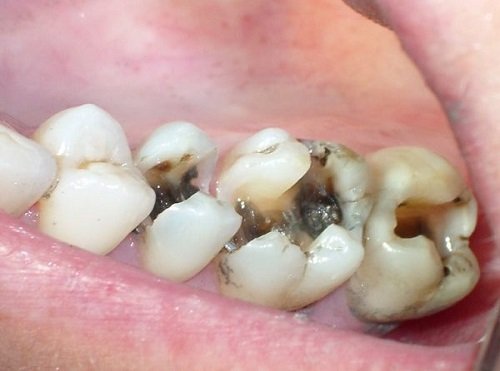 Răng sâu gây ảnh hưởng đến chức năng ăn nhai và thẩm mỹ khuôn hàm