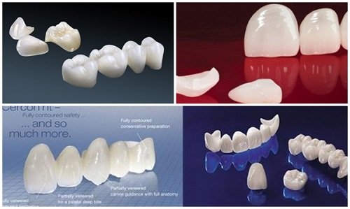 Nên chọn răng toàn sứ thay vì răng sứ kim loại khi bọc sứ cho hàm răng sâu
