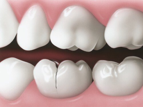 Bọc răng sứ gây hôi miệng - Tìm hiểu nguyên nhân và cách xử lý-2