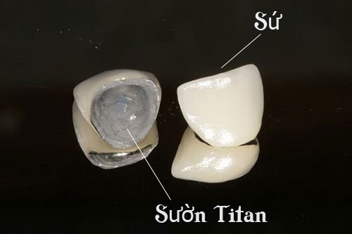 Bọc răng sứ titan có tốt không? Lưu ý bạn cần biết-3
