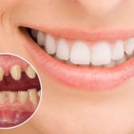 Làm răng sứ có đau không? Tìm hiểu về dịch vụ răng sứ