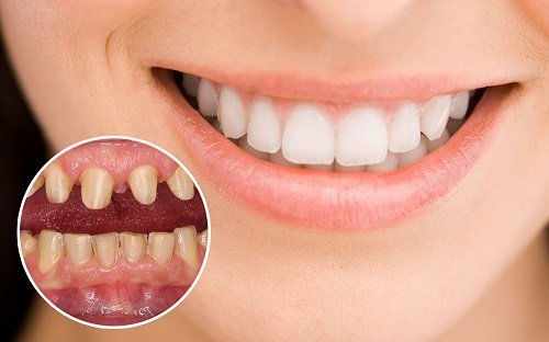Làm răng sứ có đau không? Tìm hiểu về dịch vụ răng sứ-1
