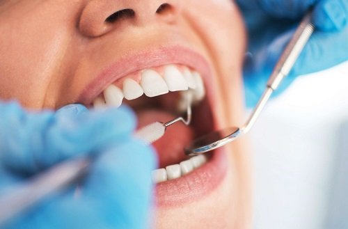 Răng bọc sứ bị lung lay phải làm sao? Cách xử lý từ nha khoa-2