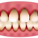 Răng sứ bị đen viền nướu - Nguyên nhân và cách khắc phục