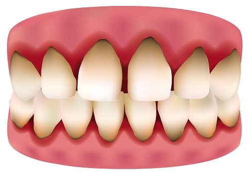 Nguyên nhân dẫn đến răng sứ bị đen viền nướu-1