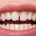 Răng sứ bị mẻ vỡ phải làm sao để khắc phục?