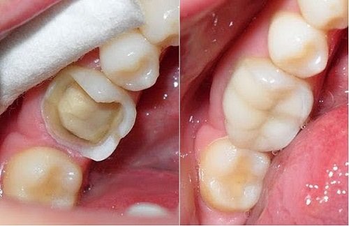 Răng sứ bị mẻ vỡ phải làm sao để khắc phục?-3