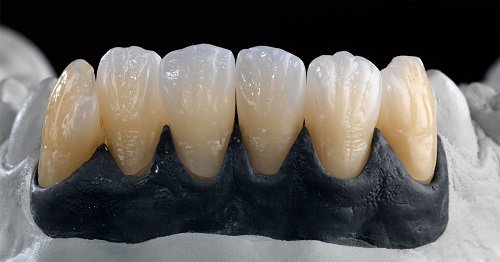 Răng sứ ceramill