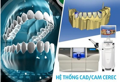 Răng sứ ceramill được sản xuất bằng công nghệ hiện đại