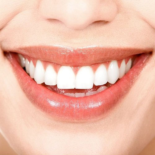 Phục hình răng sứ ceramill cho hàm răng trắng đẹp tự nhiên