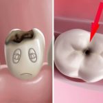 Răng sứ có bị sâu không? Khái quát ưu và nhược điểm răng sứ