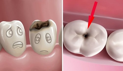 Răng sứ có bị sâu không? Khái quát ưu và nhược điểm răng sứ-1