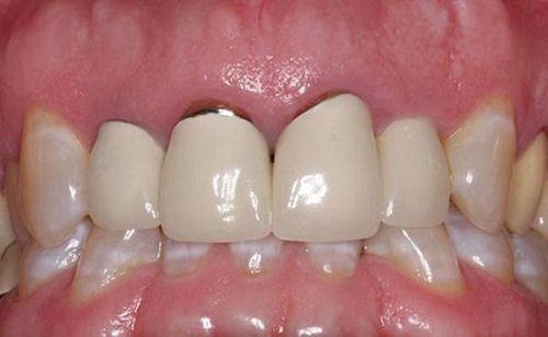 Răng sứ có bị sâu không? Khái quát ưu và nhược điểm răng sứ-3