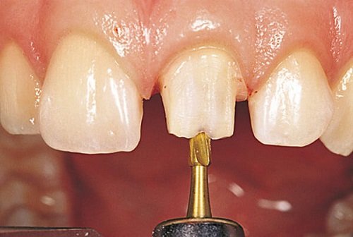 Mài răng sứ là kỹ thuật yêu cầu độ chính xác cao