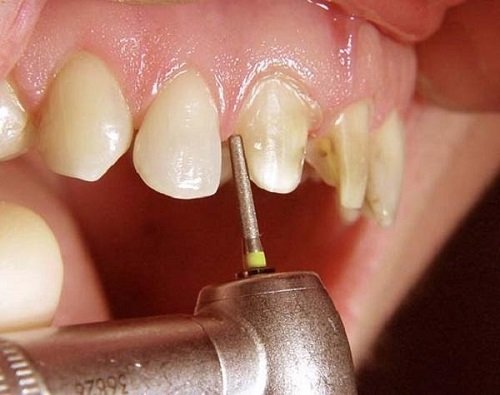 Làm răng sứ sau bao lâu thì hết ê buốt? Chia sẻ từ nha khoa-2