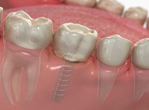 Trồng răng hàm có đau không? Giải đáp thắc mắc-4