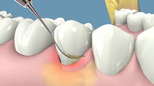 Cạo vôi răng có làm trắng răng không? Tìm hiểu thông tin 
