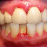Cạo vôi răng có lợi không? Tìm hiểu thông tin cụ thể