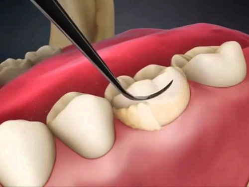 Cạo vôi răng định kỳ giúp bảo vệ răng miệng